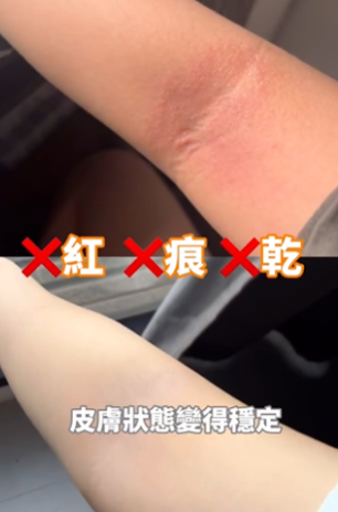 真人實證持續服用森下仁丹Bifina Si後，皮膚敏感發作次數明顯減少